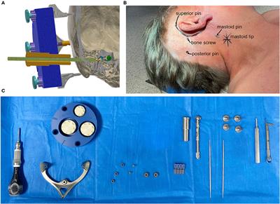 Minimally Invasive Cochlear Implantation: First-in-Man of Patient-Specific Positioning Jigs